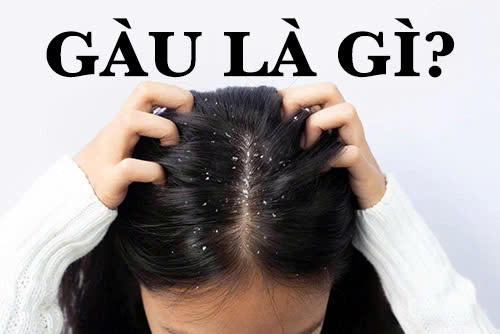 Gàu là gì – Tìm hiểu về nguyên nhân, triệu chứng và cách chữa trị hiệu quả
